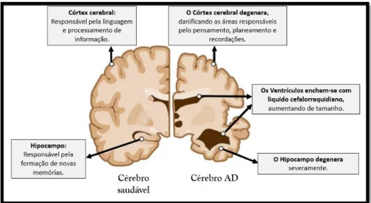 Figura 3: Representação das 3 alterações morfológicas mais significativas no cérebro AD: degeneração do córtex; 