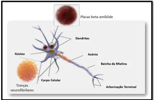 Figura 5: Deposição das placas beta amiloide e de fragmentos Tau. A formação de placas beta amiloide e o  consequente depósito neuronal, juntamente com a hiperfosforilação da proteína Tau e consequente formação de 