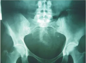 Figura 4 - Radiografia pélvica do filho da paciente, apresentando anomalia sacral.