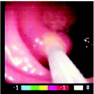 Figura 2 – Tumor carcinóide de reto. Figura 3 – Polipectomia endoscópica.