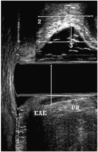 Figura 6 – Intussuscepção visualizada no quadrante posterior.