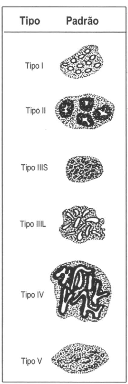 Figura 1 - Classificação macroscópica do câncer colorretal pre- pre-coce (adaptado de Kudo, 1993).