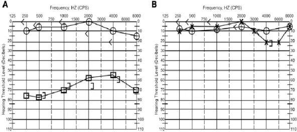 Figura 6 - (A) Audiograma de paciente com SSNI - perda neurossensorial de mais de 30 dB em mais  de 3 frequências consecutivas no ouvido esquerdo; B - Audiograma do mesmo paciente após 2 semanas de  tratamento com prednisona 1 mg/kg revelando recuperação c