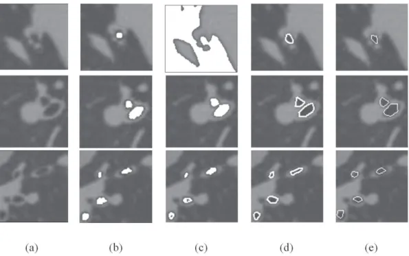 Figura 3. Resultados da segmentação das vias aéreas, nas colunas (a) recortes das imagens de TC; (b) segmentação por MLP; (c) segmentação  por CR; (d) segmentação por MCA balão; e (e) segmentação por MCA topológico adaptativo.