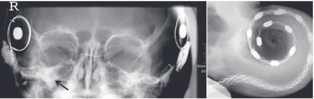 Figura 7. Radiograia de paciente implantado bilateralmente, destacando os eletrodos (Aschendorff, 2011) e ampliação em um feixe de  eletrodos dentro da cóclea (Roland Jr., 2005).