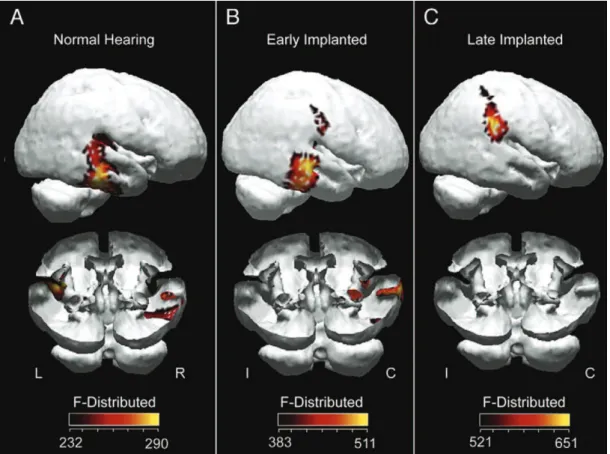 Figura 2.  Ativação de áreas corticais em resposta à estimulação sonora na audição normal (esquerda), implantação precoce (centro), e  implantação mais tardia (direita)