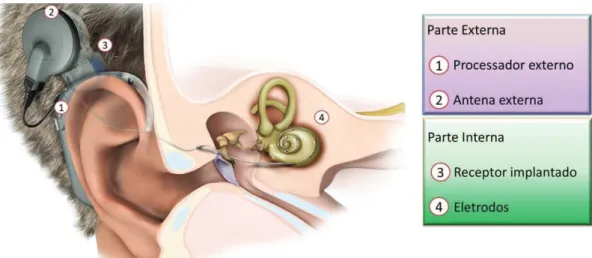 Figura 4. Esquema genérico de implante coclear. Adaptado de MED-EL (2012b). É importante salientar que não existe ligação direta entre  a parte externa e a implantada, ou seja, não há abertura na pele.