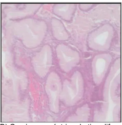 Figura 2: Histologia normal e patológica da mucosa gástrica.  