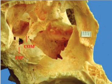 Figura 3. Forame esfenopalatino triplo localizado nos meatos nasais  superior e médio da parede lateral óssea direita da cavidade nasal