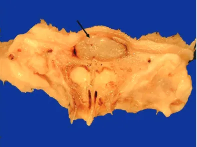 Figura 3. Corte sagital de peça mostrando a celulose incluída no  dorso nasal (seta)