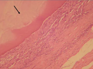Figura 4. Exame histológico mostrando a celulose (seta) em contato  com tecido subcutâneo