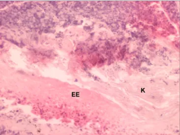 Figura 5. Corte histológico de Colesteatoma em orelha média (au- (au-mento 100X) - EE: Epitélio estratificado K: Presença de lamelas de  queratina.