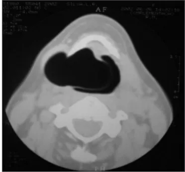 Figura 2. Parte interna da laringocele. Videolaringoscopia mostrando  tumoração ocluindo o vestíbulo laríngeo, com apagamento do seio  piriforme.