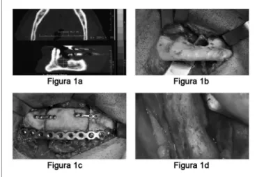 Figura 1a. Tomografia Computadorizada da mandíbula mostrando o  ameloblastoma destruindo parte da cortical mandibular.