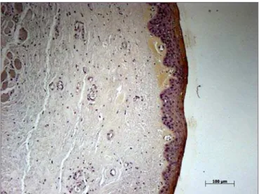 Figura 5. Região intermediária de prega vocal - Lâmina com método  imunohistoquímico mostrando presença de inúmeras células do  epi-télio coradas em marrom.