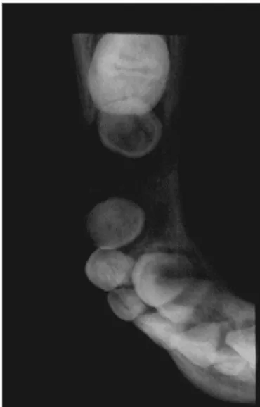 Figura 3. Linfoma de Burkitt - radiografia panorâmica - Área radiolúcida  difusa na região de pré-molares mandibulares
