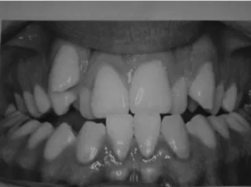 Figura 3 - Aparelho expansor do tipo Haas ( mucodentosuportado)  cimentado  nos  dentes  previamente  ao  procedimento  de  expansão  maxilar.