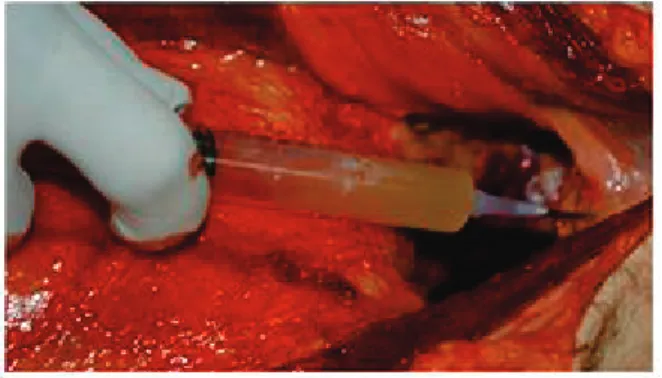 Figure 12. Pericardial fluid collection during a medico-legal autopsy (Source: kindly provided by  Jerónimo Fontesanta, INMLCF 2011) 