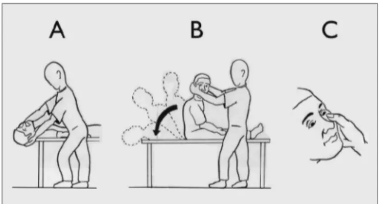 Figura 1. Prova de Dix-Hallpike (1952)36: A) paciente, sentado sobre  a maca, gira a cabeça 45 graus para o lado a ser avaliado; B) com a  ajuda do examinador, o paciente assume rapidamente a posição de  decúbito dorsal e cabeça pendente, mantendo a posiçã