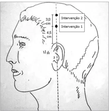 Figura 1. Pontos utilizados para acupuntura para ambos os grupos  - Intervenção 2 Intervenção 1