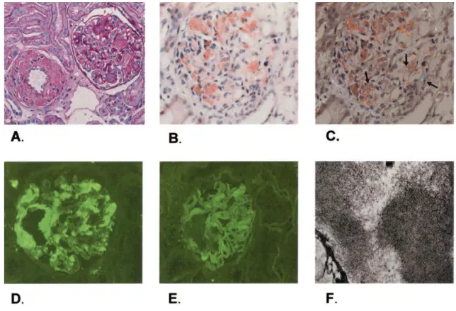 Figura 6: Biopsia renal de um doente com amiloidose primária (Dember, 2006, p. 3461).  