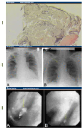 Figura 11: Biopsia pulmonar transbrônquica, que revela uma infiltração de células  mononucleares e um depósito amilóide nodular (Ege, Uzaslan &amp; Ursavas, 2006, p