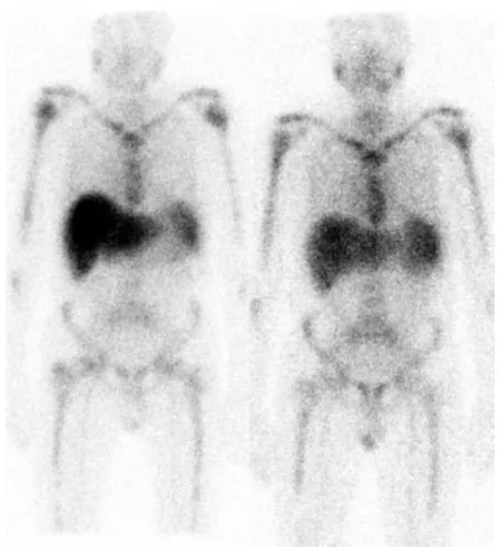 Figura 13: Cintigrafia pré e pós-tratamento com bortezomib (Wechalekar, Lachmann &amp; 