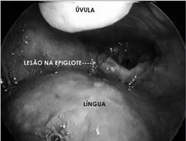 Figura 1. Lesão na superfície superior direita da epiglote - histoplas- histoplas-mose de laringe.