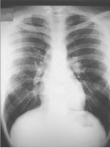 Figura 2. Radiografia de tórax sem alterações. 