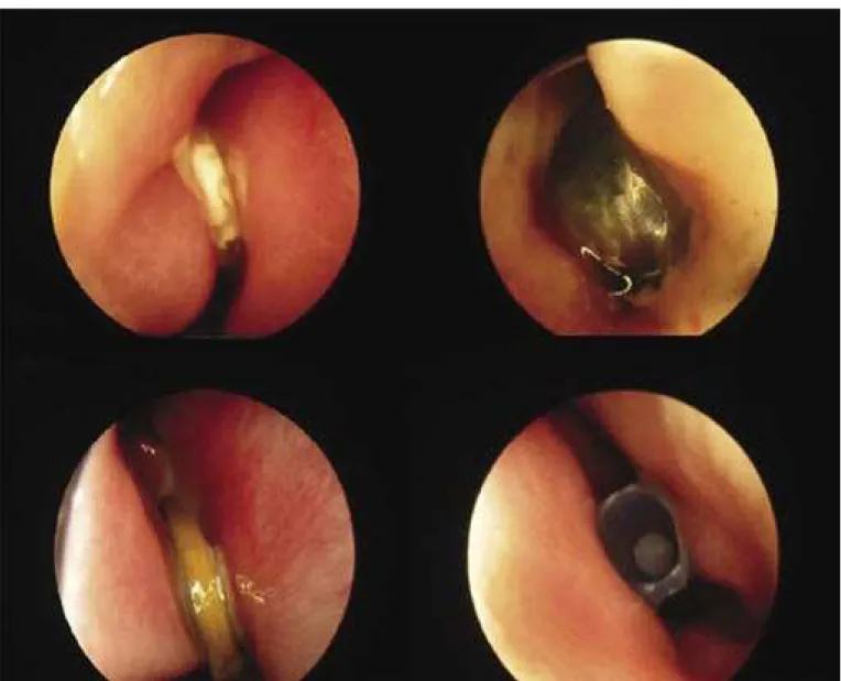 Figura 2. Corpos estranhos de fossas nasais (em sentido horário, a partir de superior esquerdo): botão, fragmento de brinquedo, tampa de  caneta, moeda.