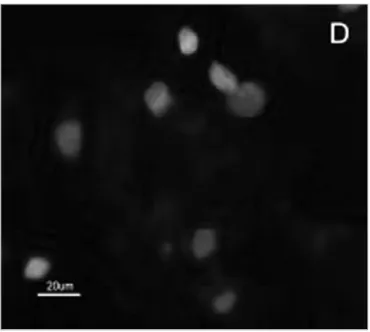 Figura 2. Fotomicrografia de imunofluorecencia indireta onde percebe- percebe-se a diferença de reatividade das células de CEC em comparação com  as células da mucosa normal ao MoAb DH2 (AntiGM3).
