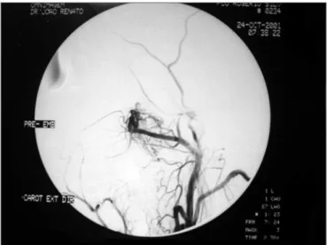 Figura 1. Arteriografia de nasoangiofibroma pré-embolização - artéria  maxilar com ramos para o tumor.
