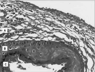 Figura 3. Imagem digitalizada de lâmina, com corte transversal de  colesteatoma,  corada  em  Hematoxilina-Eosina;  apresentando  suas  partes constituintes: A
