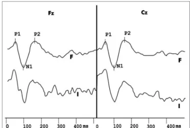 Figura  2. Mismatch Negativity evidenciado pela onda de diferença  obtida com os estímulos infreqüentes e freqüentes no protocolo de  estimulação auditiva com variação de duração do grupo controle.