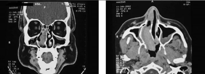 Figura 1. Dois cortes da tomografia computadorizada do paciente J.C. mostrando uma lesão com densidade de partes moles na cavidade nasal direita.