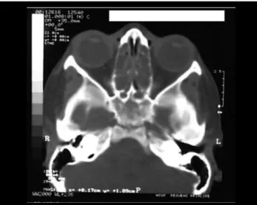 Figura 2. Corte coronal evidenciando velamento de seios maxilares e células etmoidais e obliteração bilateral do infundíbulo.