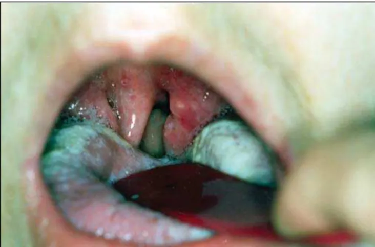 Figura 1. Orofaringoscopia mostrando aspecto eritematoso das tonsilas palatinas, edema de úvula e monilíase em língua.