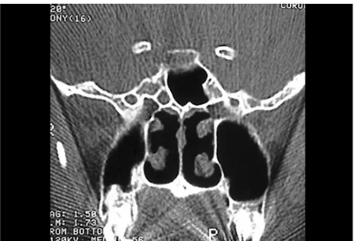 Figura 5. Tomografia de paciente com fístula liquórica em lâmina cribriforme durante sinusectomia etmoidal E.