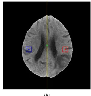 Figure 2. (a) Original brain CT image; (b) After skull removal and realignment, the ideal midline  is drawn in yellow