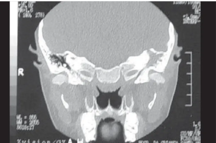 Figura 1. Extenso abscesso cerebral no lobo temporal esquerdo. Figura 2. OMC colesteatomatosa à esquerda com erosão óssea e deiscência do tegmen tympani.
