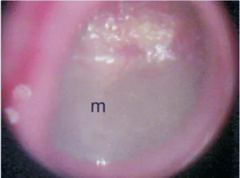 Figura 1. Otomicroscopia mostrando intensa opacificação da meta- meta-de posterior da membrana timpânica (*), estando a metameta-de anterior com transparência normal (seta)