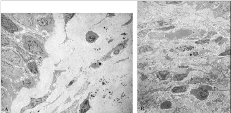 Figura 2: A- Lâmina própria com fibrose intensa e poucos elementos do infiltrado celular inflamatório (2000X)
