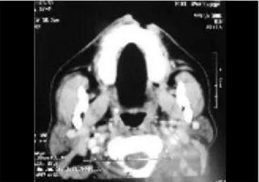 Figura 7. Tomografia Computadorizada de Seios paranasais, corte axial mostrando perda de continuidade da pele que corresponde a úlcera da região nasolabial.