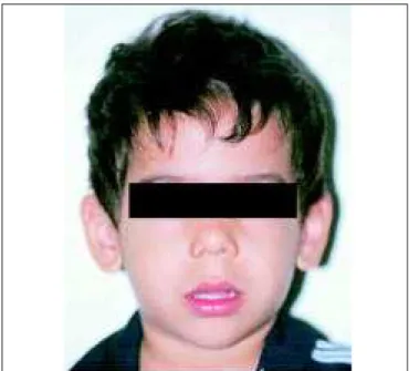 Figura 1. Criança respiradora bucal crônica, com sinais da Síndrome da Face Alongada