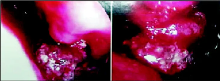 Figura 3.  Intra-operatório: rinolito de cor acinzentada envolto em mucosa polipóide sangrante ao toque.