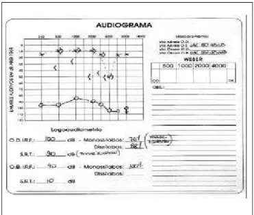 Figura 3. Audiometria demonstrando uma perda mista à direita.