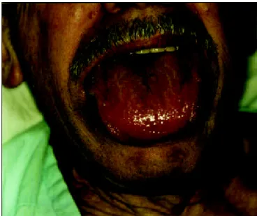 Figura 1.  Macroglossia pode ser observada associada à massa submentoniana/submandibular, sem alteração da coloração da língua ou lesões nodulares.