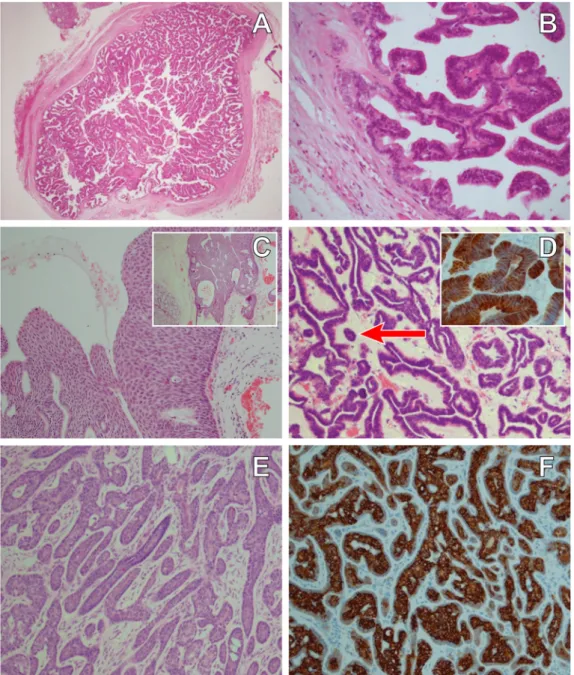 Fig. 2 a An encapsulated intraductal papilloma in a minor salivary gland. b Higher magniﬁcation illustrating the delicate papillary network of cell-lined vascular fronds with the occasional goblet cell; atypia and mitoses are absent (a, b by courtesy of Dr