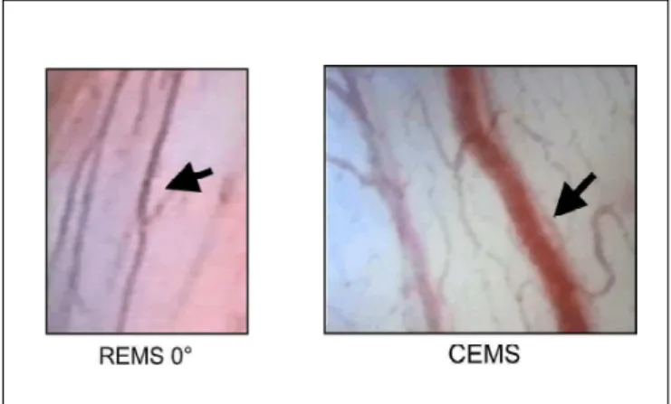 Figura 6. Microvaso tipo paralelo ectásico, identificado através da REMS 0° e CEMS, localizado na área II