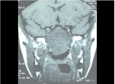 Figura 3. RNM de seios paranasais, corte coronal, pré-operatório.